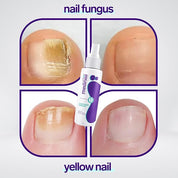 Jaysuin Nail Fungus Spray 100ml